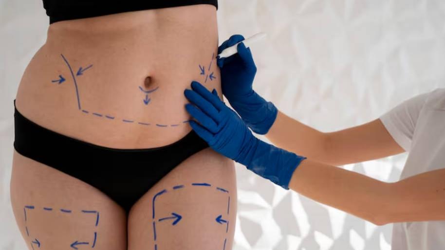 Does Cryolipolysis Treatment Really Work? 7 Things to Know Before Fat Freezing- Does Cryolipolysis Treatment Really Work? 7 Things to Know Before Fat Freezing-