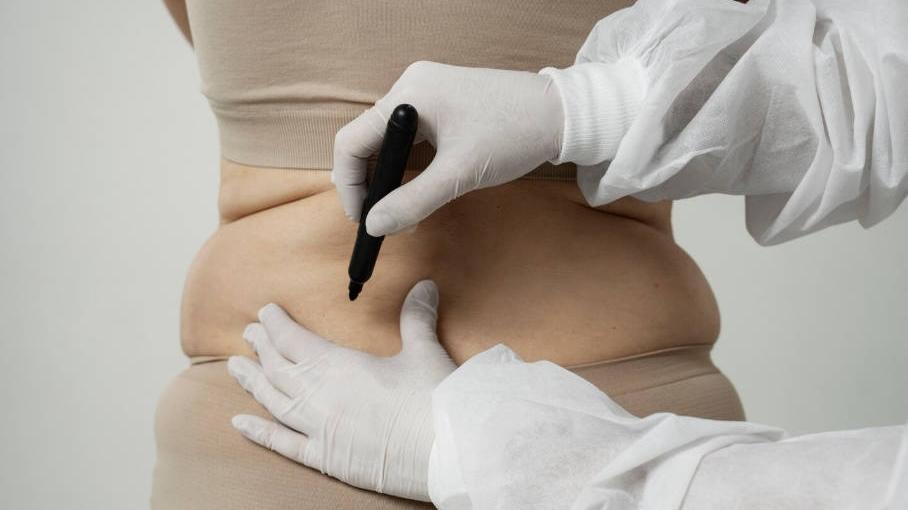 Cryolipolysis Treatment Areas: How Clinics Select Applicators and Plan Sessions- Cryolipolysis Treatment Areas: How Clinics Select Applicators and Plan Sessions-
